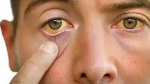 What Level of Jaundice is Dangerous?